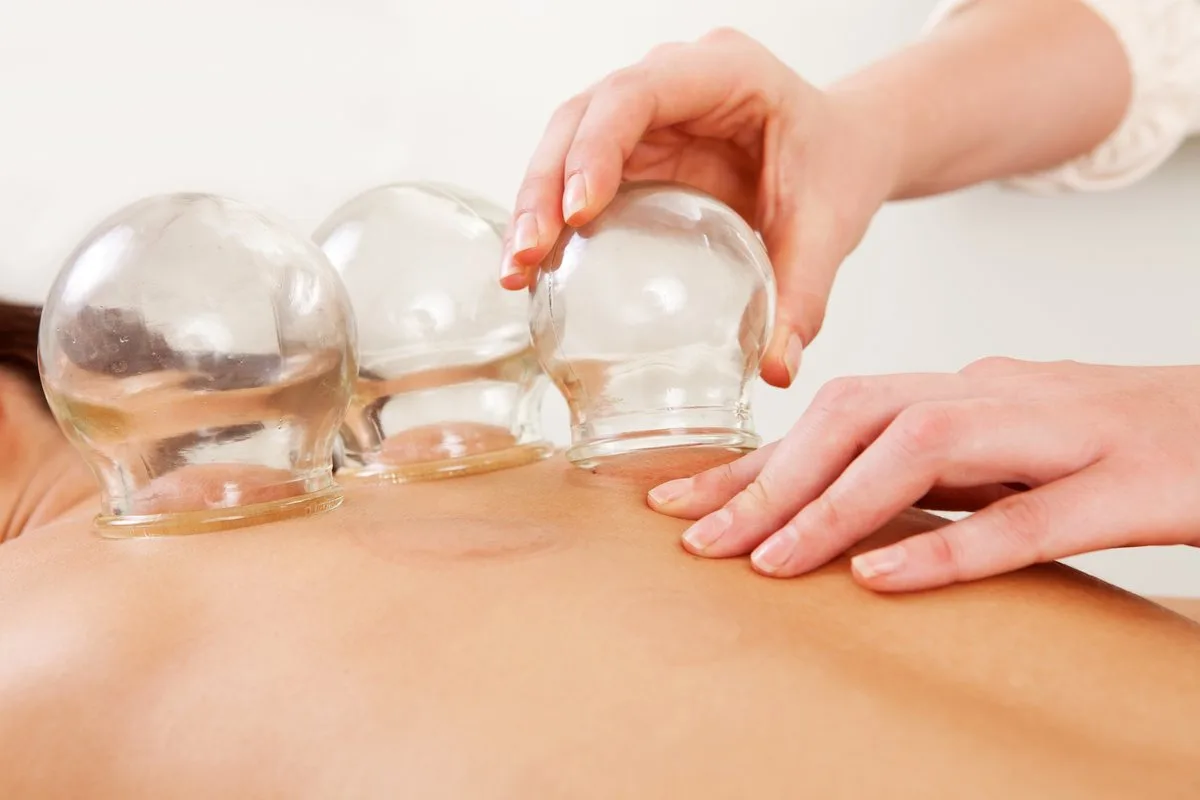 Cupping therapy — glass cups applied along the back