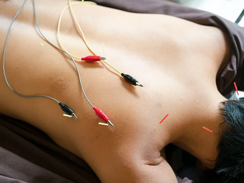 Electroacupuncture — fine needles with electrode leads on the upper back